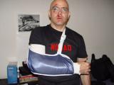 The sling before the cast